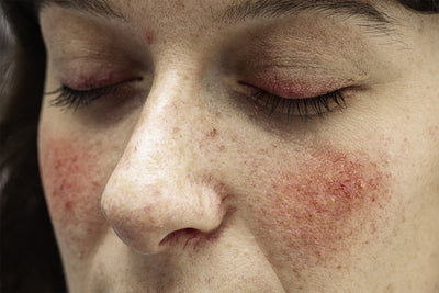6 Methods on How To Get Rid of Rosacea